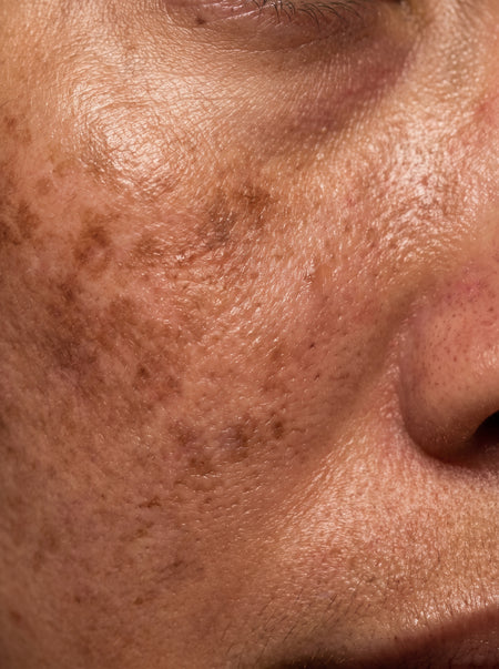 Melasma y Manchas
